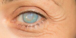 sintomas de oncocercosis ocular