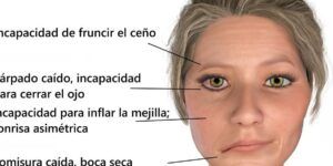 sintomas de paralisis facial por tumor