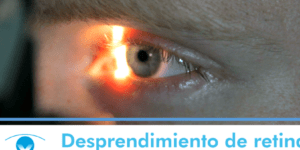 sintomas del desprendimiento de retina