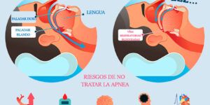sintomas y causas de apnea