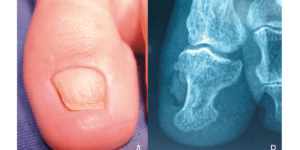 sintomas y tratamiento de exostosis