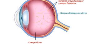 sintomas y tratamiento del desprendimiento vitreo