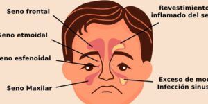 sinusitis y problemas de vision