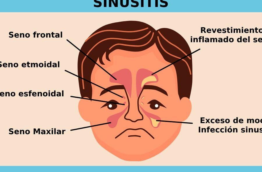 sinusitis y problemas de vision