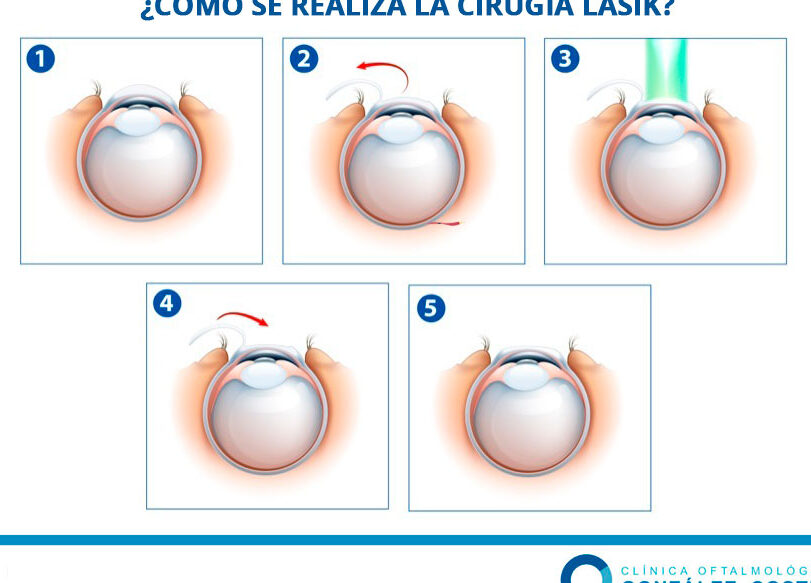 tecnicas quirurgicas para corregir astigmatismo
