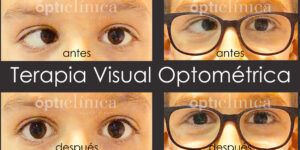 tipos de estrabismo y terapia visual
