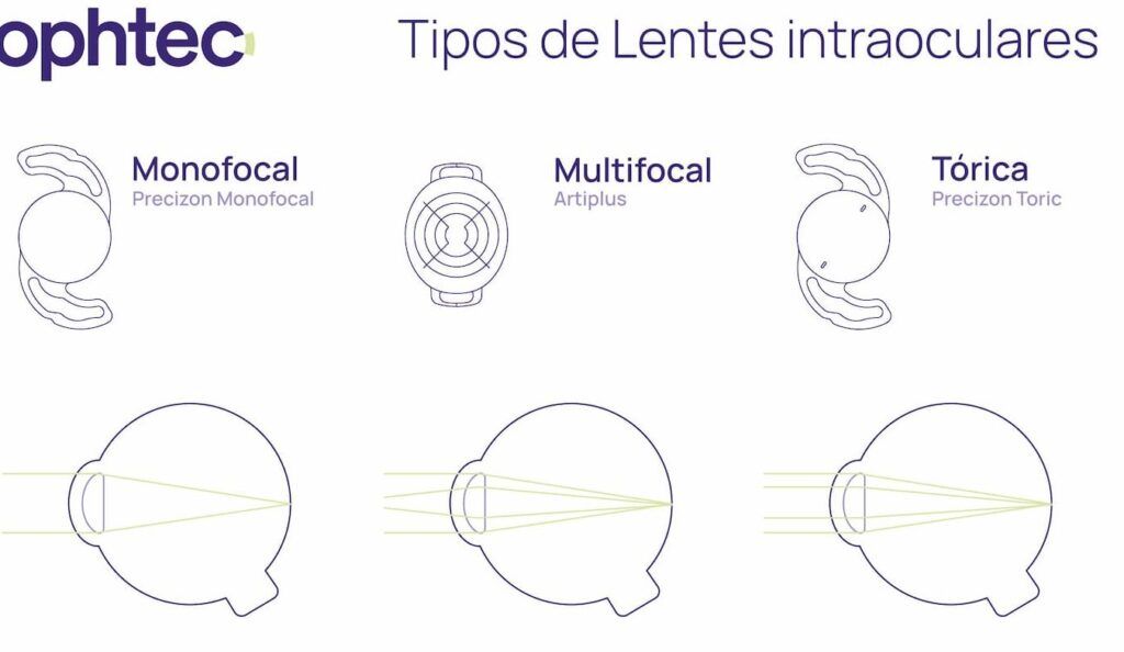 Tipos de lentes intraoculares multifocales: ventajas y desventajas