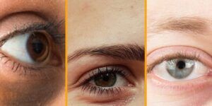 tipos de ojeras por enfermedad