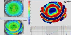 topografia corneal y costos adicionales