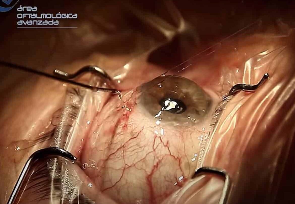 tratamientos no quirurgicos para glaucoma