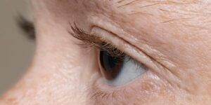 verrugas alrededor de los ojos