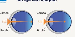 vision borrosa con 10 dioptrias